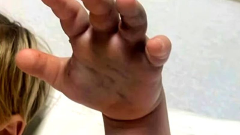 Morsure d’un serpent venimeux dans une crèche : une réaction discrète face à une situation d’urgence