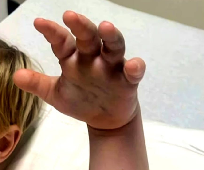 Morsure d’un serpent venimeux dans une crèche : une réaction discrète face à une situation d’urgence
